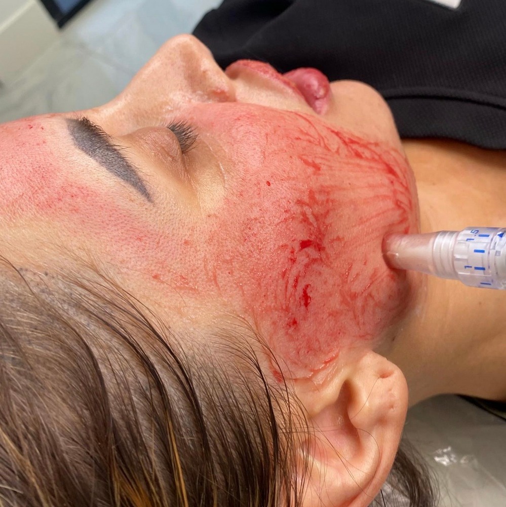 PRP Facial PRP Facial