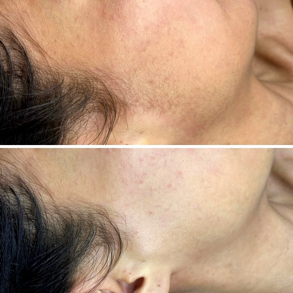 Dermaplane Dermaplane