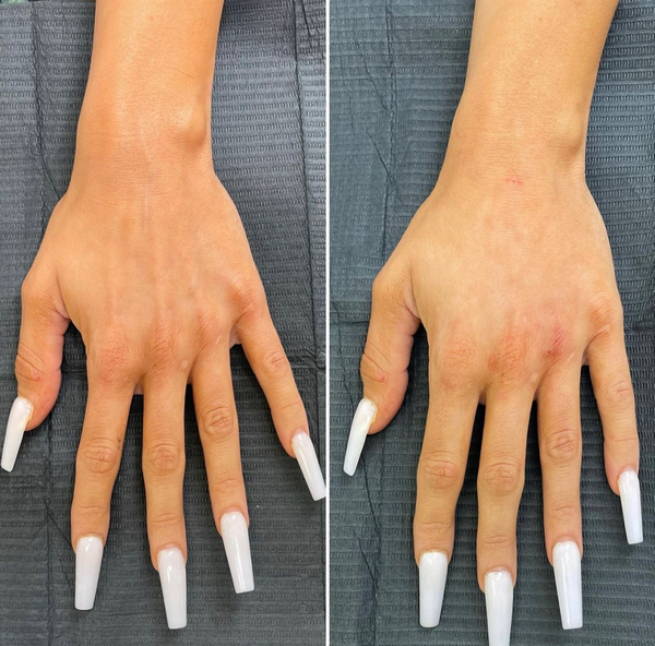 Hand Rejuvenation