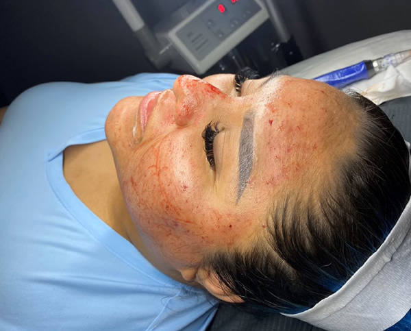 PRP Facial