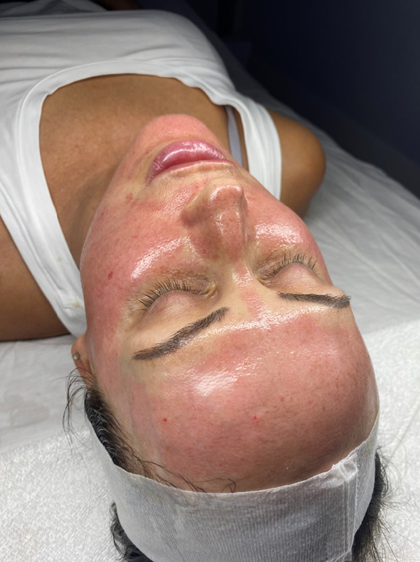 microneedling