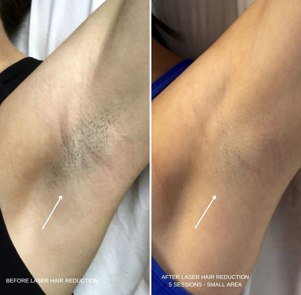 laser hair reduction laser hair reduction