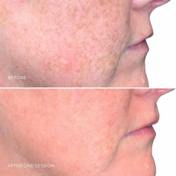 anti pigment laser 1 anti pigment laser